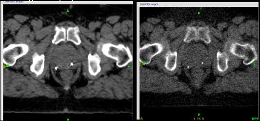 Patient Image: Prostate