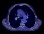 PET/CT PLANNED