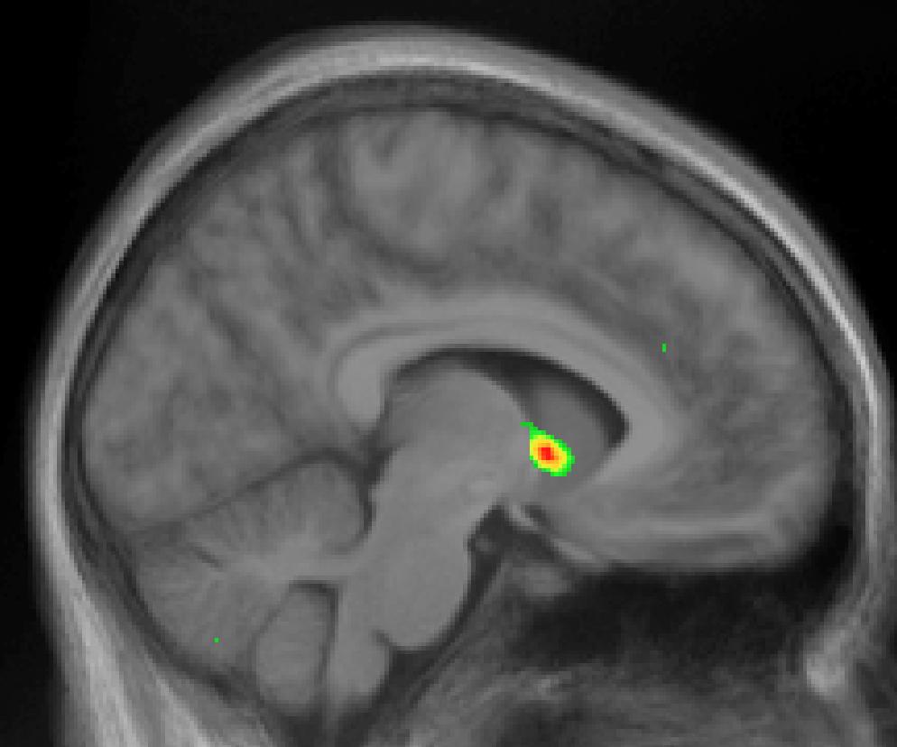 Nucleus Accumbens (NA): Center for all Motivation and Pleasure Functional MRI (fmri) scan showing the Nucleus Accumbens in the brain of someone listening to their favorite music