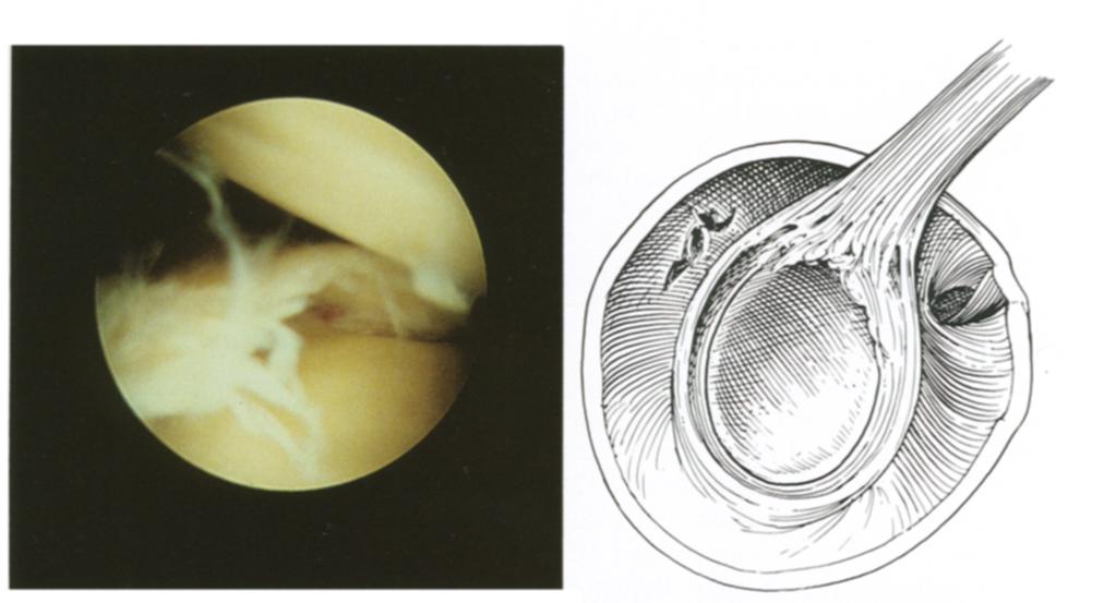 276 S. J. SNYDER ET AL. la,b FIG. 1. Arthroscopic (A) and schematic (B) illustration of I SLAP lesion.