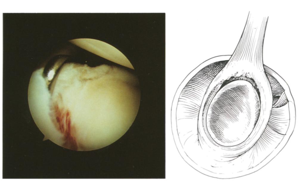 IV Bucket-handle tears of the superior labrum similar to those of III were noted, but in addition, the tear extended into the biceps tendon.