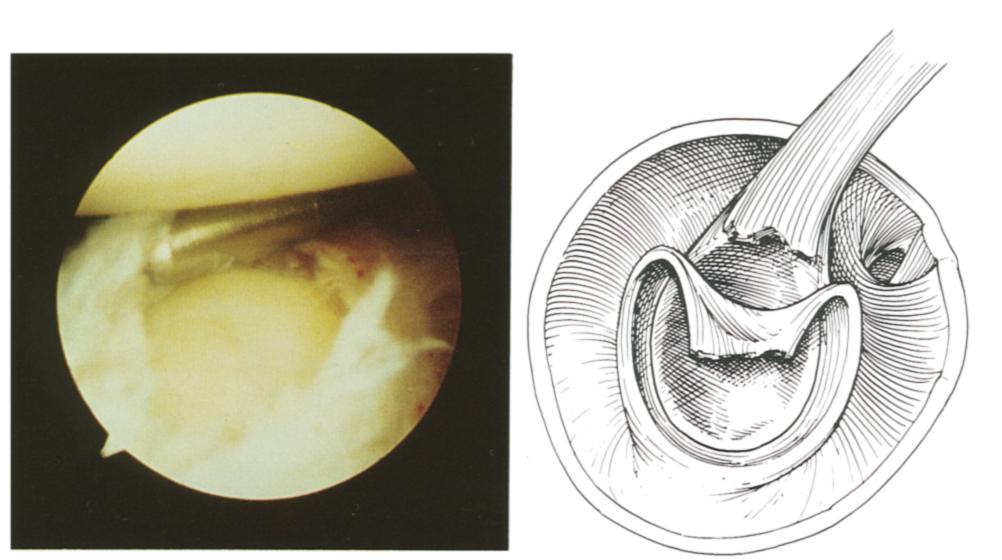 In II lesions, the superior glenoid neck below the biceps anchor was abraded to bleeding bone after debridement of the frayed labral tissue, to promote healing of the avulsed labrum to the underlying