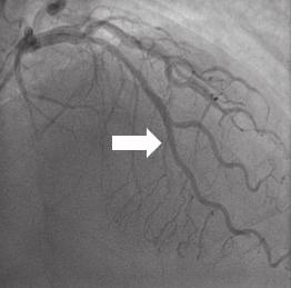 Coronary angiography in a 58-year-old male patient, who had chest pain caused by myocardial bridging.