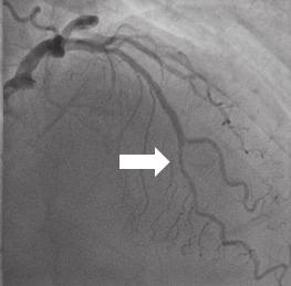 LAD, left anterior descending coronary artery. A B Fig. 2. The relationship between the location of MB and type of ER.