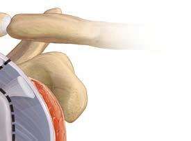 Soon after surgery, you may need to start physical therapy for your shoulder. Manipulation.