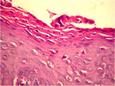 Annular erythematous and infiltrated plaques with elevated borders