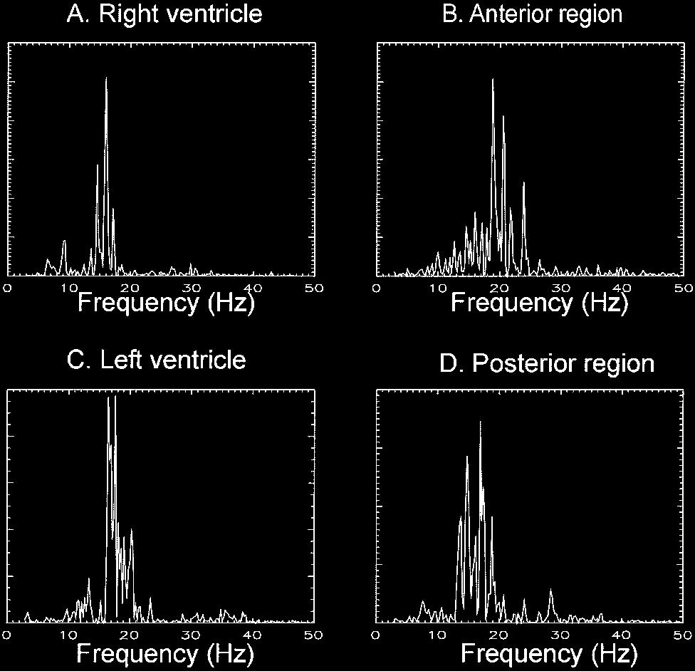 Histograms of local velocity vectors showed no preferential orientation (n 4 hearts). Hence, the analysis of local velocity vectors did not support the hypothesis that VF is an organized process.