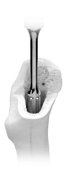 The specific objectives for reaming for the Trabecular Metal Primary Hip Prosthesis are: 1 Help ensure that the prosthesis is placed in a neutral position within the femur.