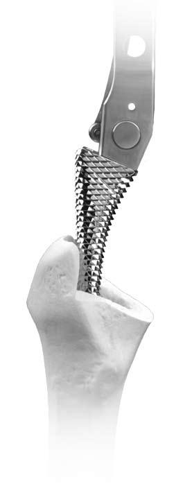Trabecular Metal Primary Hip Prosthesis Surgical Technique Fig. 10 When rasping, be sure that the rasp advances with each blow of the mallet.