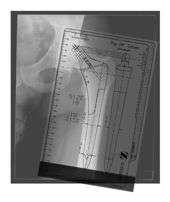 Trabecular Metal Primary Hip Prosthesis Surgical Technique Component Size Selection/ Templating It is recommended that three radiographic views be evaluated when templating.
