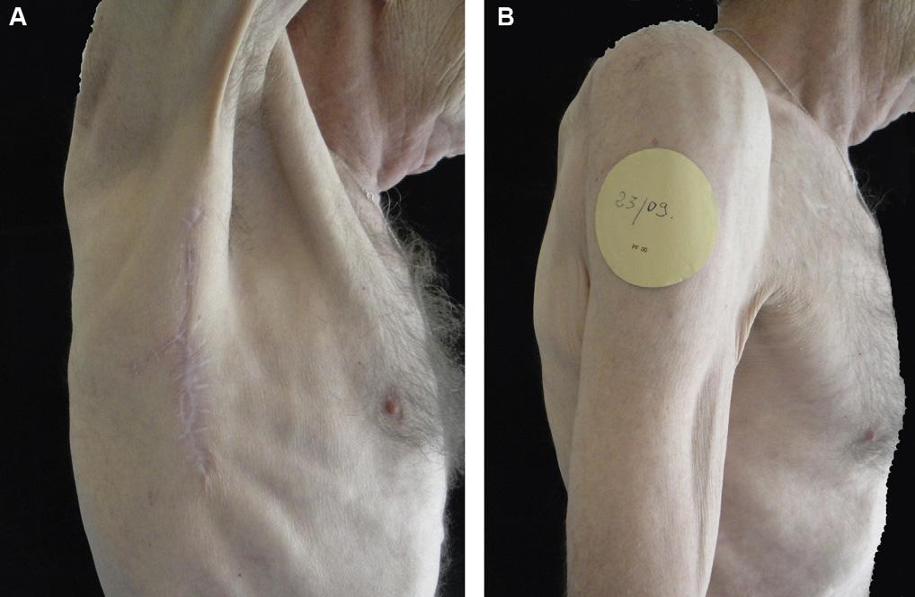 The thoracodorsal artery perforator flap is a reliable flap. In a series of 100 thoracodorsal artery perforator flaps in 99 patients reported by Hamdi et al.