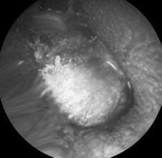 Otoscopy: showed a white pearly mass behind an intact tympanic membrane