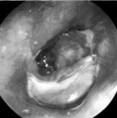 Case 3: 35 years old male patient presented with persistent foul-smelling