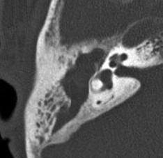 Otoscopy: showed cholesteatoma involving the whole tympanic cavity (T4)