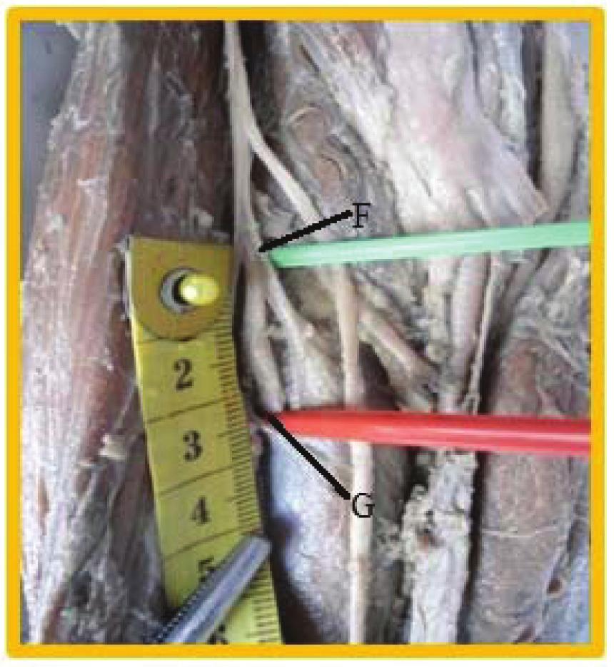 Proximal Border of the Head of the Radius Shown by Green Pin (Marked F) Morphology of the arcade of the Frohse (proximal border of the superficial lamina of the supinator) (Figure 3).