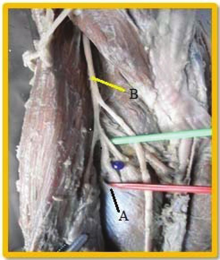 Figure 3: Depicts Proximal Border of Superficial Lamina of the Supinator Raised by Red Pin (Marked A), Radial Nerve (Marked B) The exit point of the PIN between the 2 laminae of the supinator muscle