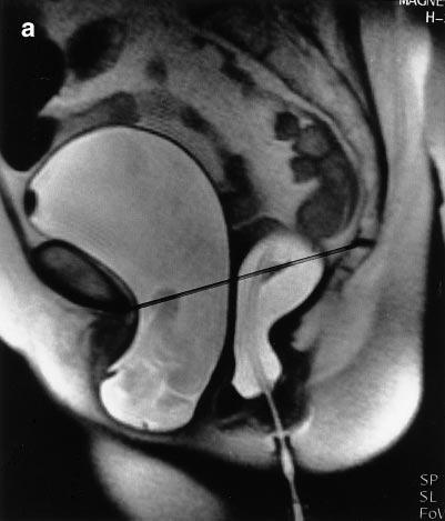 detecting rectoceles (9). Figure 1. MR image of a 59-year-old woman demonstrating a small rectocele (a).