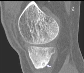Fig.12: CT osteoblastoma