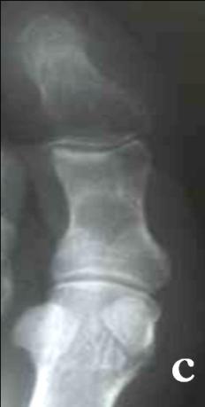 10: MRI femur showing the