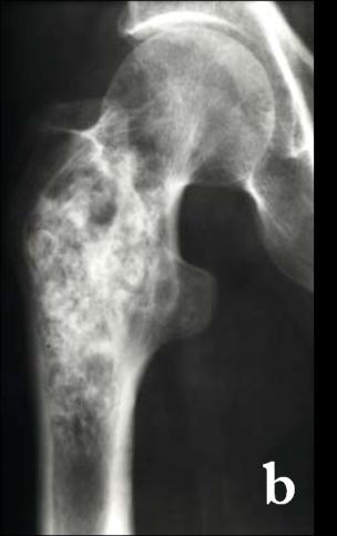 11:Osteoblasto-ma with large