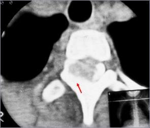 9ab: CT showing a tiny