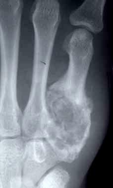 femur showing bone