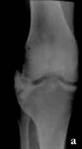 lower end of femur. Fig.