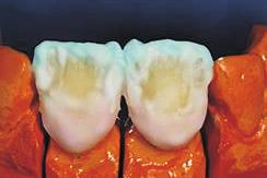 Individualizing with VITAVM 9 NOTE: By using VITA SHADING PASTE stains it is not only possible to characterize the outer surface of VITABLOCS restorations but