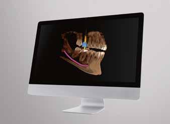 10 I 11 Implantology Chairside Place implants safely and precisely in just a single visit CEREC is also part of the safe and individual chairside implantology solution from Dentsply Sirona.