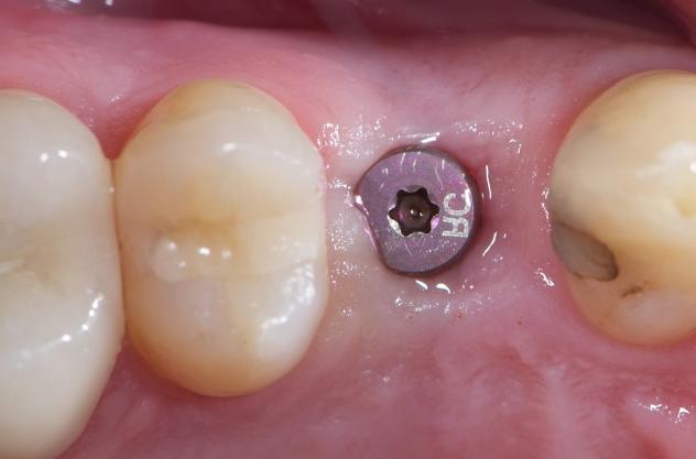 also be the most challenging and frustrating step for the implant surgeon in the 3D guided implant workflow.
