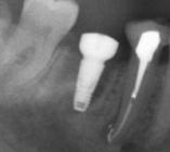 Restoration An implant abutment is screwed into the