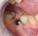 The crown (prosthesis) is cemented onto or screwed