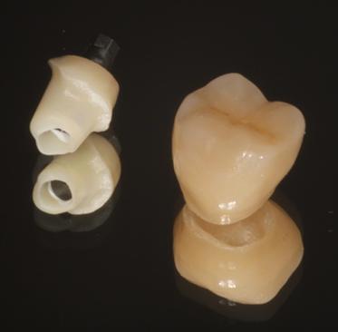 crown chairside using CEREC