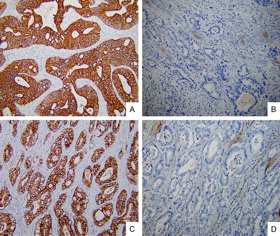 Figure 1. AEG-1 were positive expression in GBC tissues nd its cytoplsm ws stined brown (200 ) (A). AEG-1 hd negtive expression in GBC tissues nd its cells were not stined (200 ) (B).