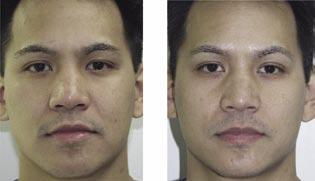 2a: Facial appearance prior to treatment. Note the asymmetry of the eyes and the upper lip, and the prominence of the nasolabial groove on the left side.