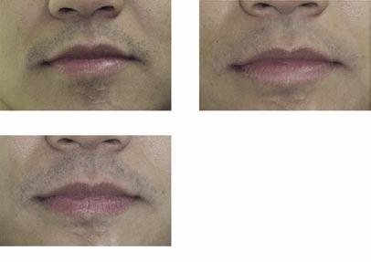 Clinically, it is evident that changes occur, increasing the symmetry of the eyes, the upper lip, and the nasolabial groove on the left side.