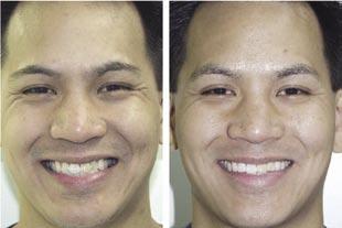 4a: The appearance of the smile before treatment. Figure 4 4b: The appearance of the smile after treatment with the Homeoblock appliance.