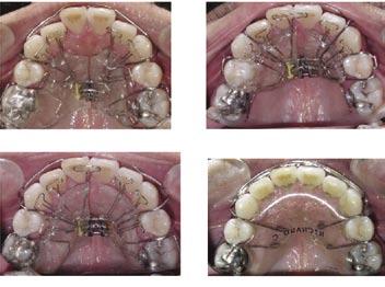 Note that the lateral incisors are excluded from the arch and are in cross-bite. 5b: The changes in form of the upper arch after nine months of treatment with the Homeoblock appliance.
