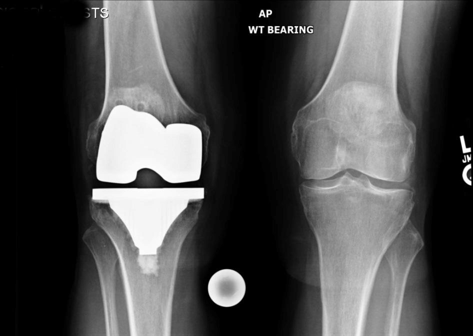 It is also helpful to obtain images of the patient taken prior to the initial joint replacement.