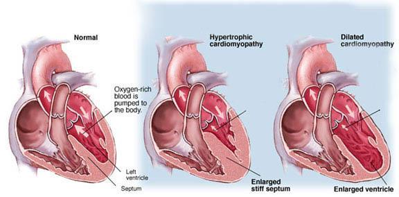 Types of heart failure: HF with reduced EF (HFrEF)-