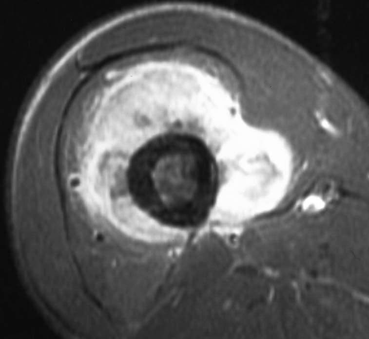 160 S Ehara Figure 3 Transcortical infiltration of osteosarcoma (19-year-old man). Axial T1-weighted image with fat suppression after intravenous injection of Gd-contrast medium.