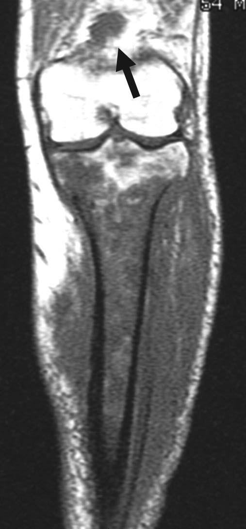 Coronal T1-weighted image demonstrates a dominant lesion in the right proximal femur with infiltration into the periosteal region.