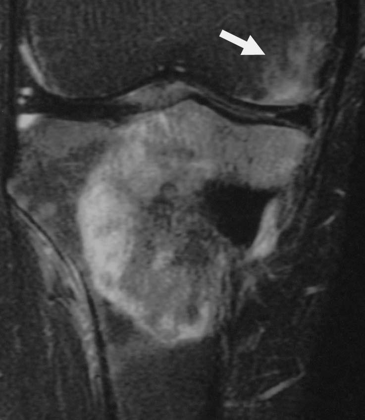 MR imaging in staging of bone tumors 161 involvement [5]. Gd-chelate contrast has been used to determine tumor extent on MR imaging, particularly in joint involvement.