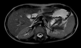 11 Case 7 20 year-old case of Thalassemia with repeated blood transfusion. What are the differences between the 2 images? Normal MRI Abnormal MRI What is abnormal here?