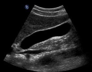 2 Case 1 45 year-old female with RUQ pain radiating to right shoulder and aggravated by fatty meals associated with vomiting. What is the most likely diagnosis? Gallstone +/- cholecystitis.