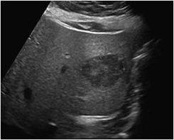 Case 3 6 US for chronic hepatitis B virus patient. What is your diagnosis? Hypoechoic lesion within the liver (look like a mass), from ultrasound we can t tell if it is benign or malignant.