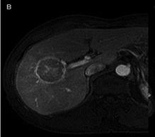 liver start to take and lesion is almost similar, surrounded by capsule which is compressed and hyperintense Late phase