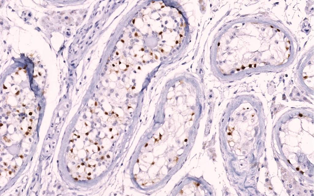 cells), CIS containing seminiferous tubules on the right side (CIS cells associated with Sertoli cells on the basal lamina).