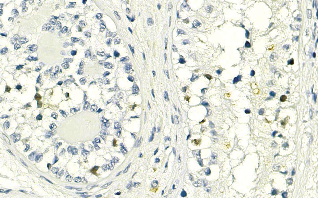 disease (g) Figure 2: Immunohistochemical staining of the gonadoblastoma and carcinoma in situ lesions of patient 2.