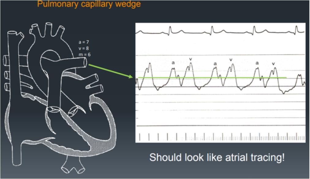 77 V-wave: Filling of atrium, Larger than a wave in LA/smaller than a wave in RA. Y-descent: Opening of atrioventricular valve, ventricular filling [1]. Figure 3: Atrial tracing.